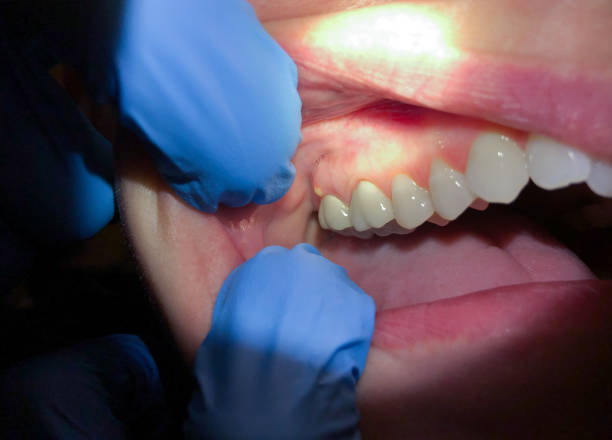 Best Broken or Cracked Tooth Emergency Dentist in Arlington Heights, WA